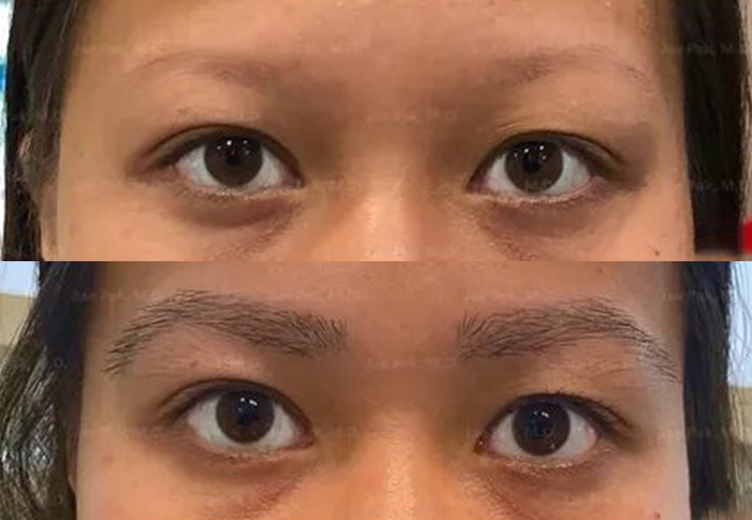 CareBridge - Eyebrow Transplant - Before and after [02]