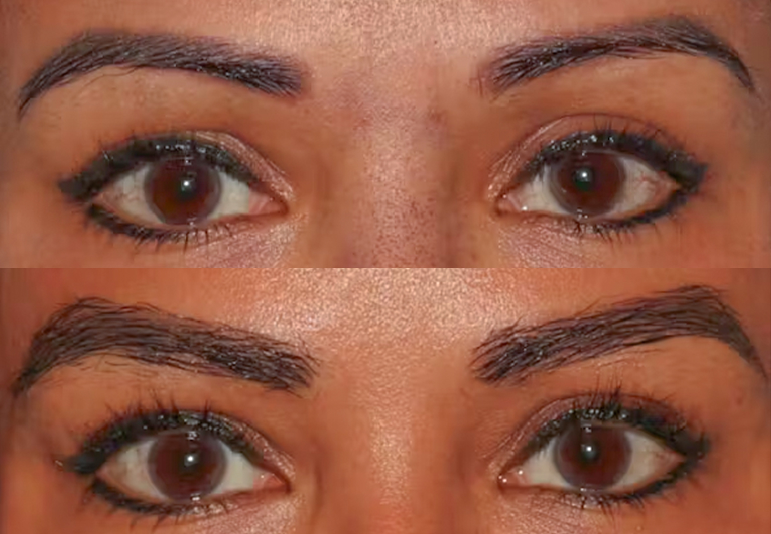 CareBridge - Eyebrow Transplant - Before and after [03]