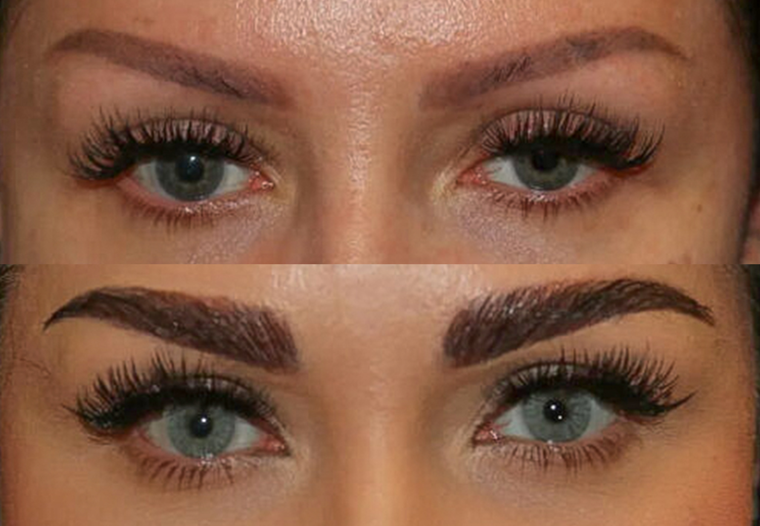 CareBridge - Eyebrow Transplant - Before and after [04]