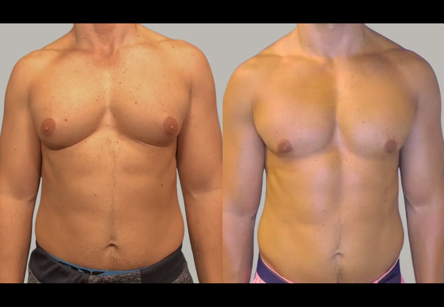 CareBridge - Gynecomastia - Before and after [01]