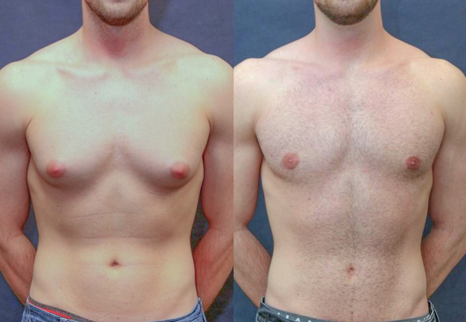 CareBridge - Gynecomastia - Before and after [02]
