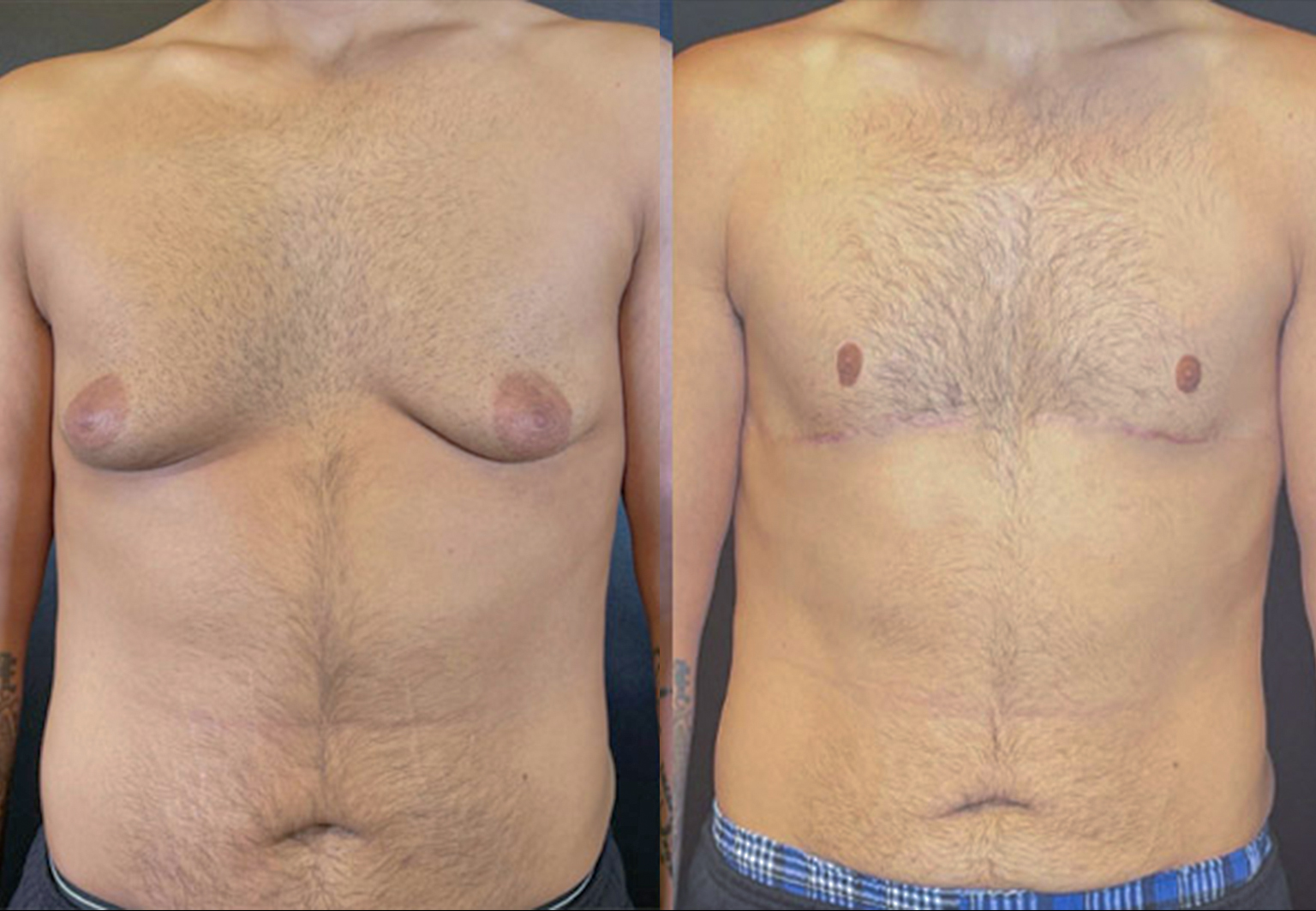 CareBridge - Gynecomastia - Before and after [03]