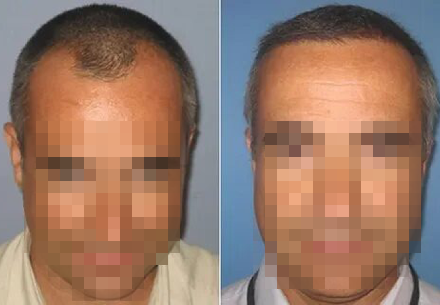 CareBridge - Hair Transplant - Before and after [01]