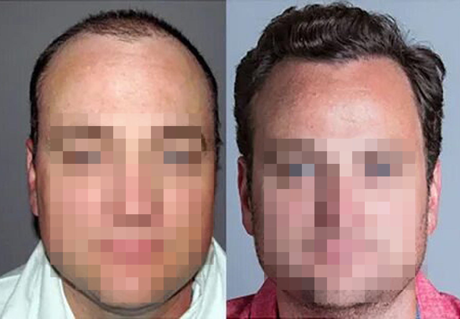 CareBridge - Hair Transplant - Before and after [03]