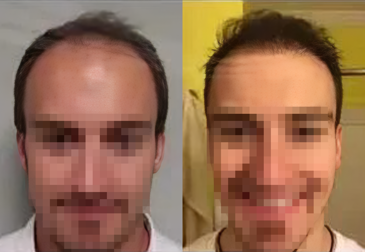 CareBridge - Hair Transplant - Before and after [08]