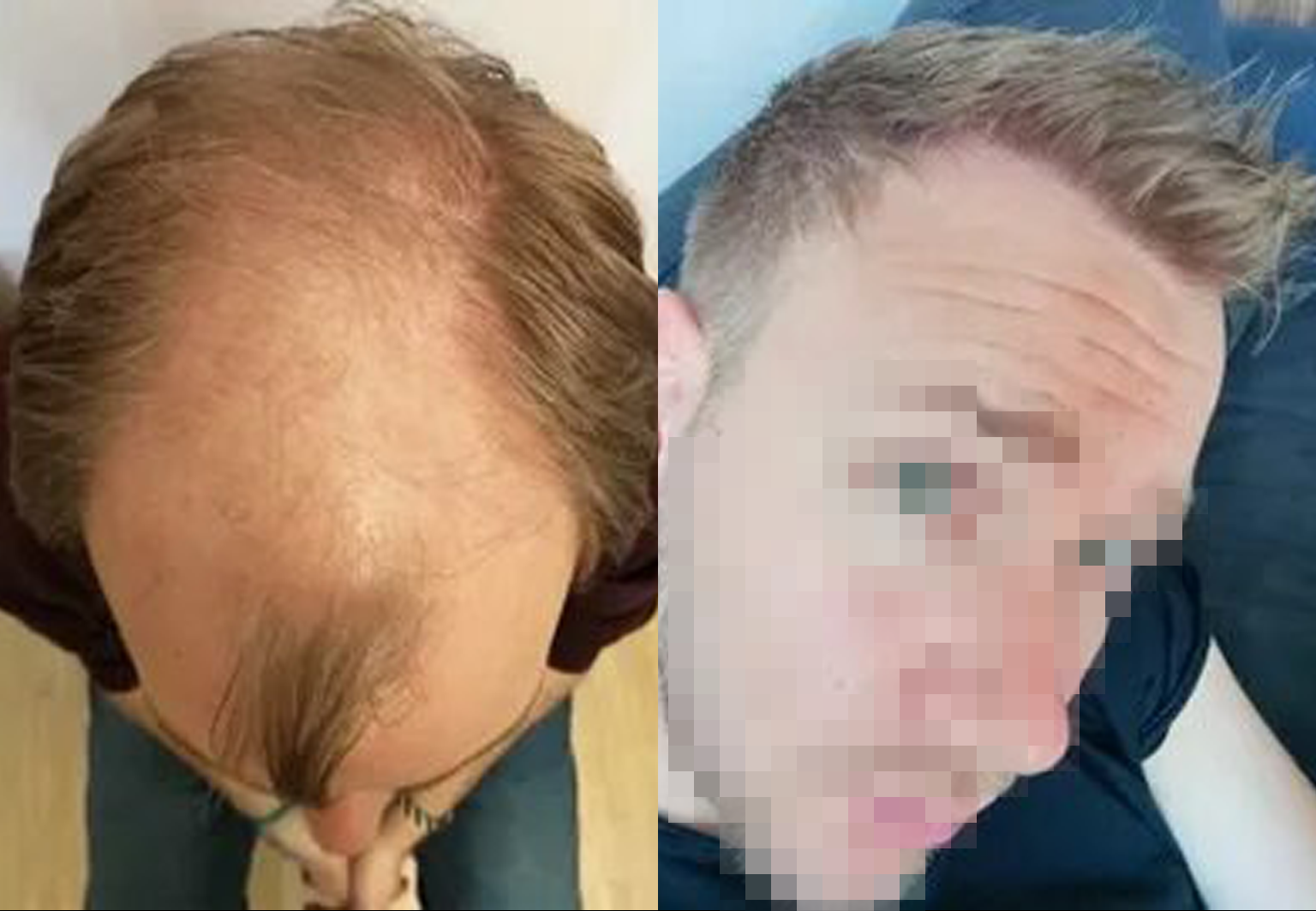 CareBridge - Hair Transplant - Before and after [09]