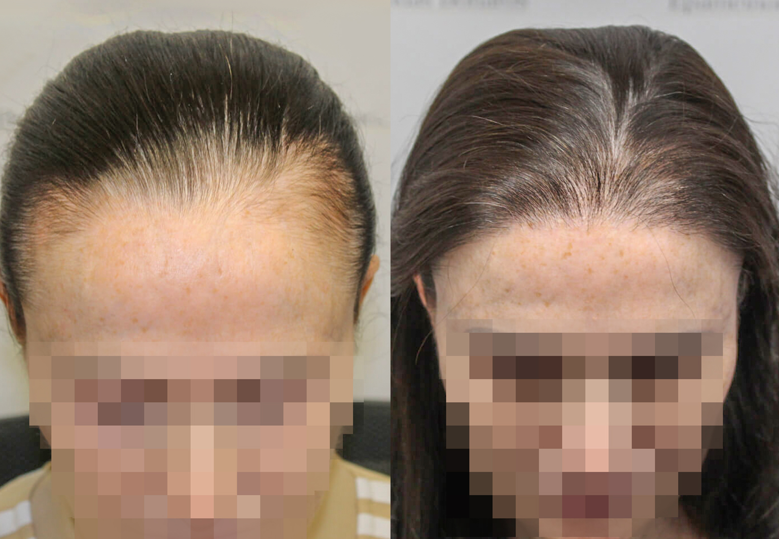CareBridge - Hair Transplant For Women - Before and after [01]