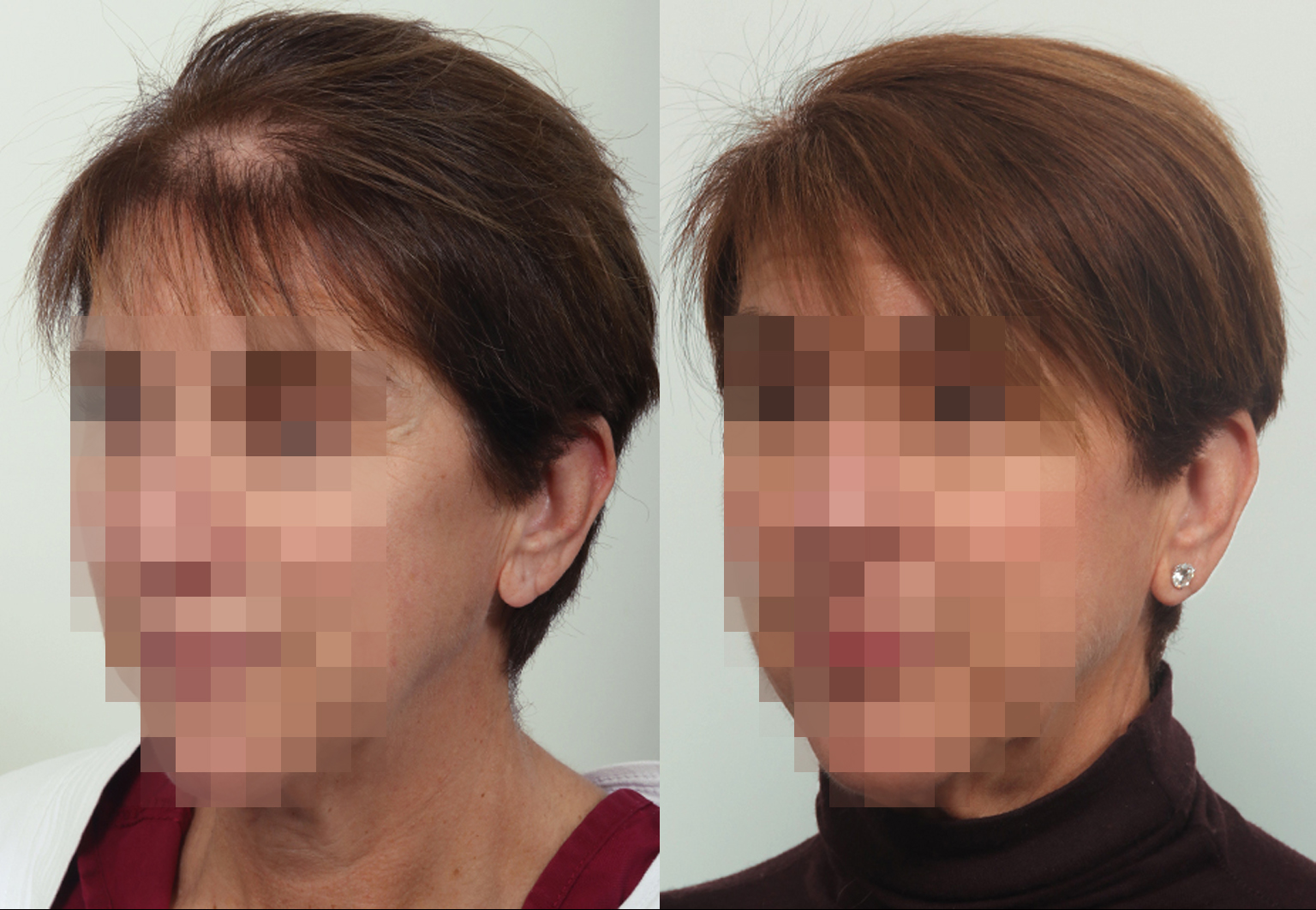 CareBridge - Hair Transplant For Women - Before and after [02]