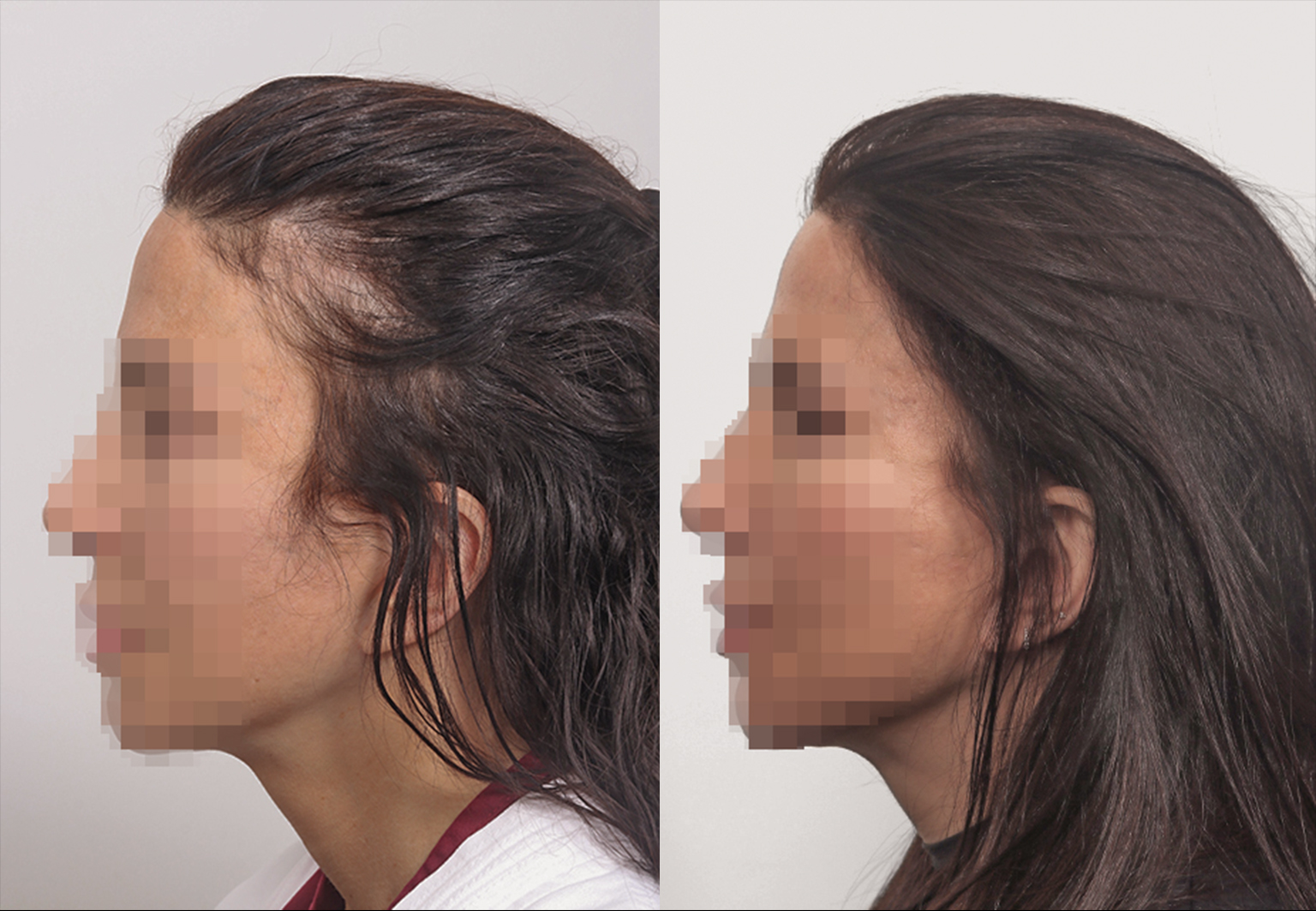 CareBridge - Hair Transplant For Women - Before and after [03]