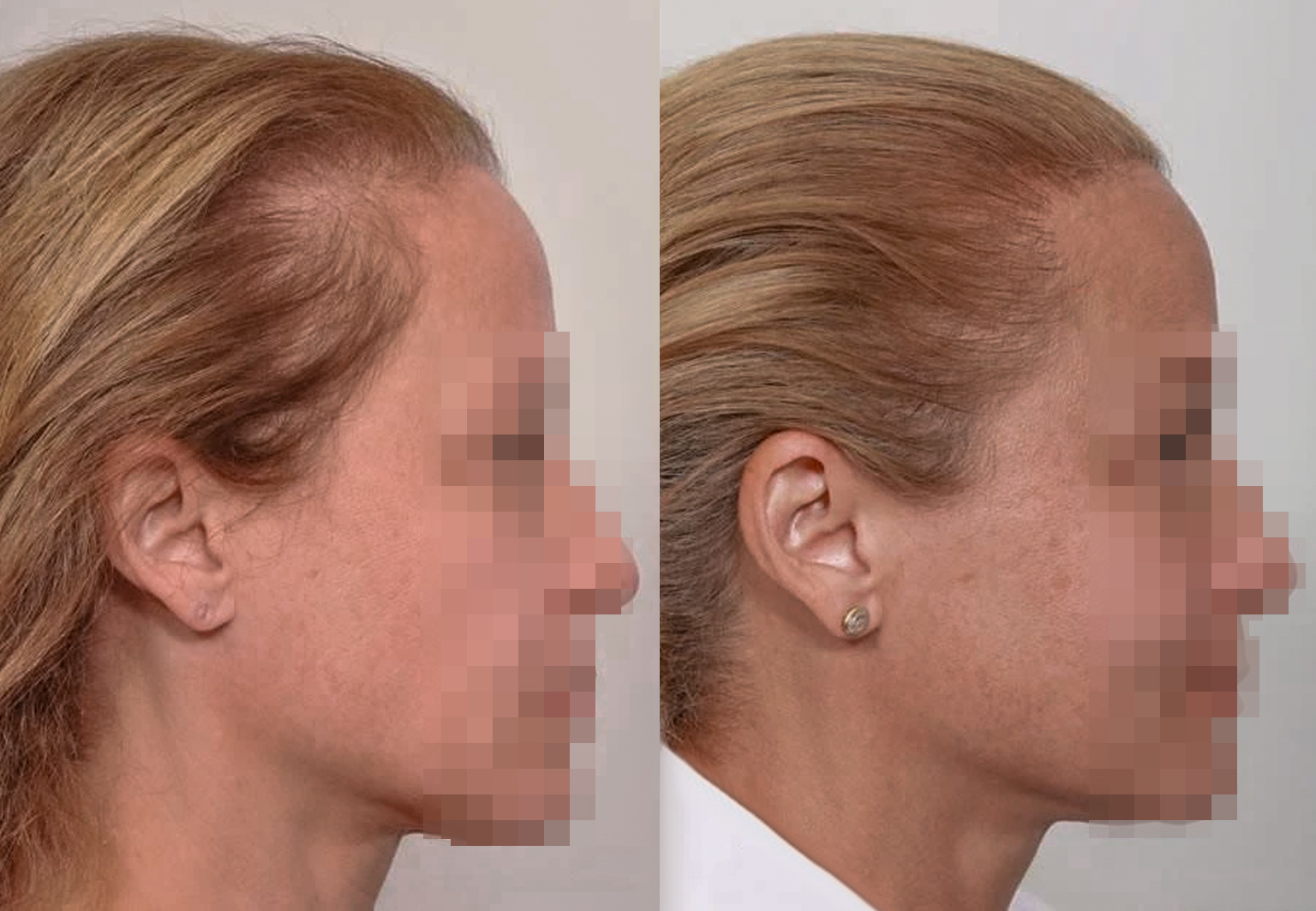 CareBridge - Hair Transplant For Women - Before and after [04]