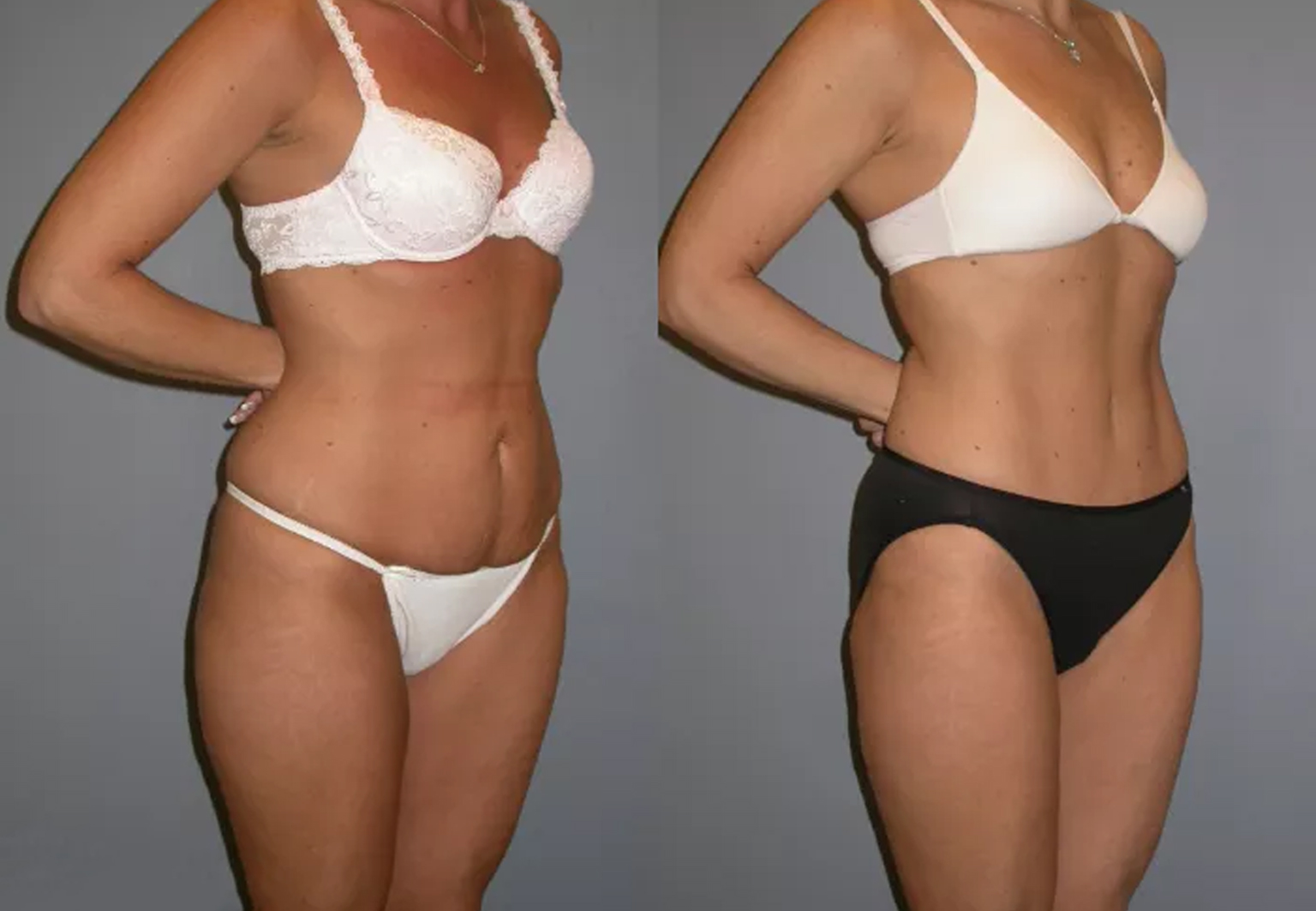CareBridge - Liposuction - Before and after [01]