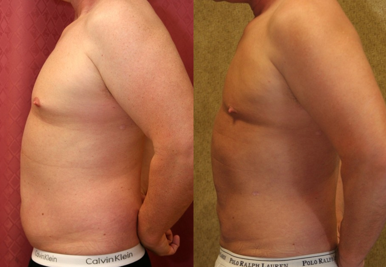 CareBridge - Liposuction - Before and after [03]