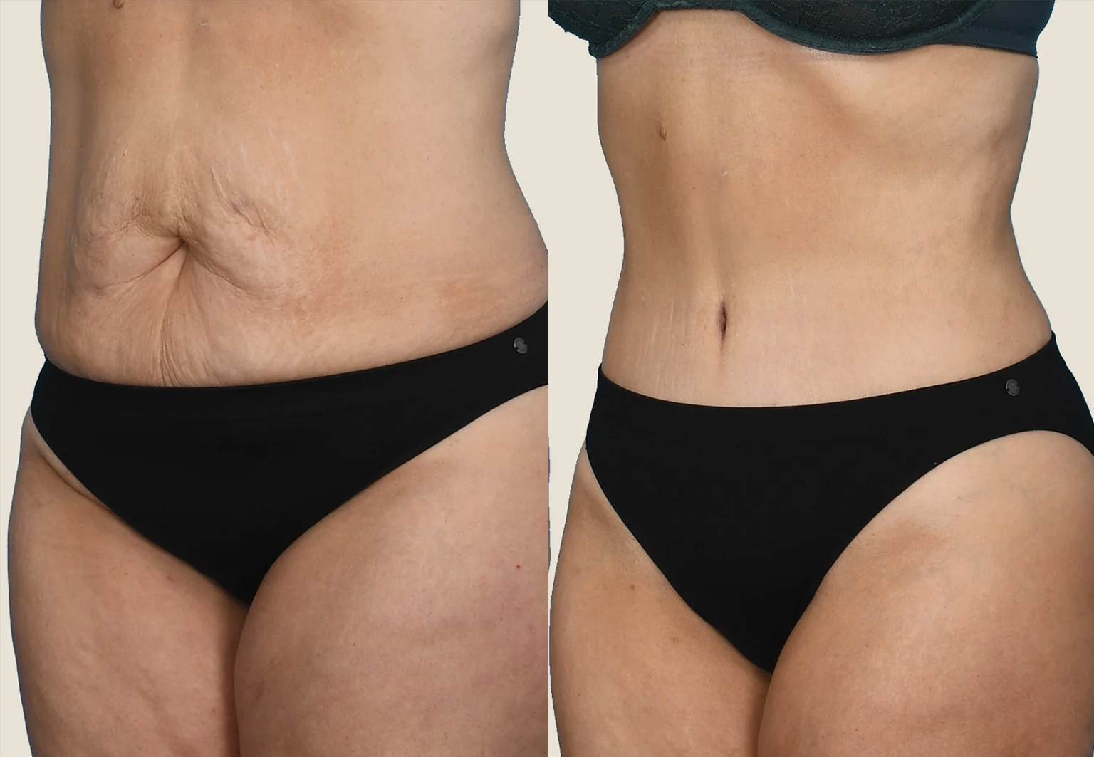 CareBridge - Liposuction - Before and after [04]