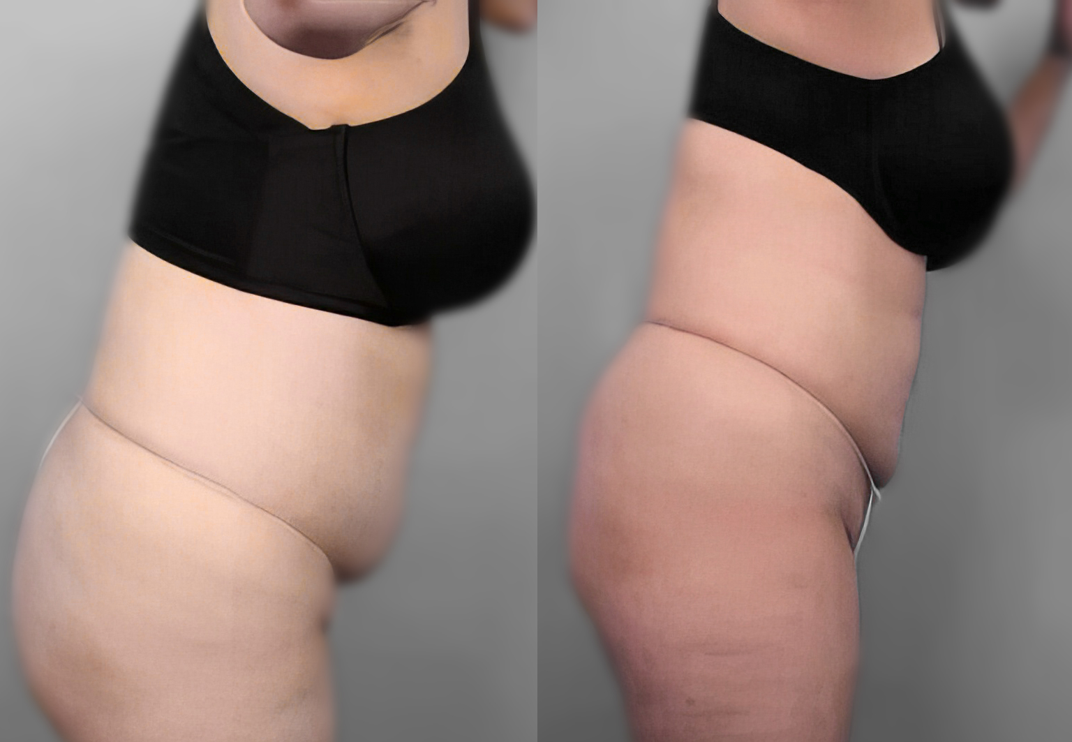 CareBridge - Tight Lift - Before and after [01]