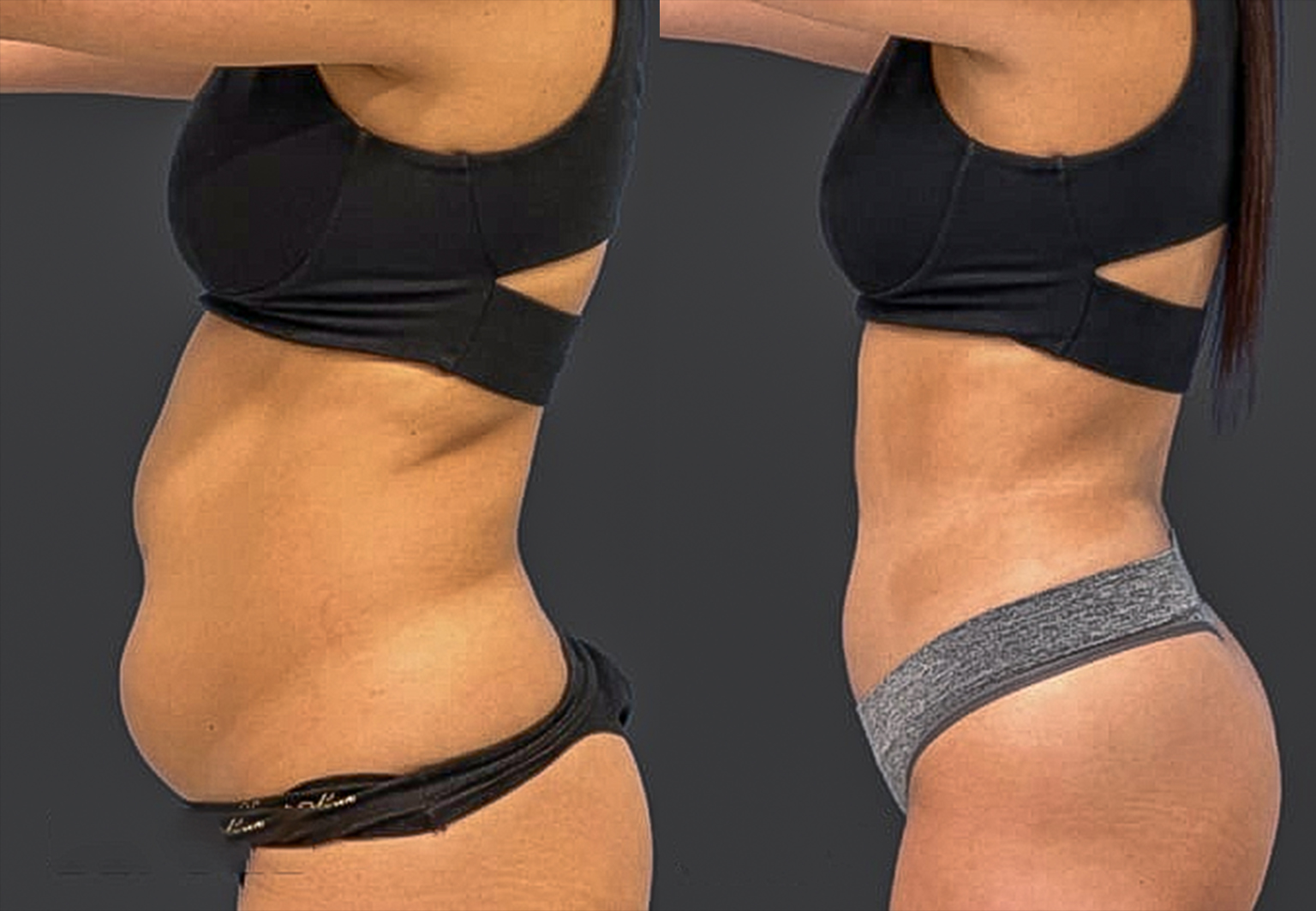 CareBridge - Tight Lift - Before and after [02]