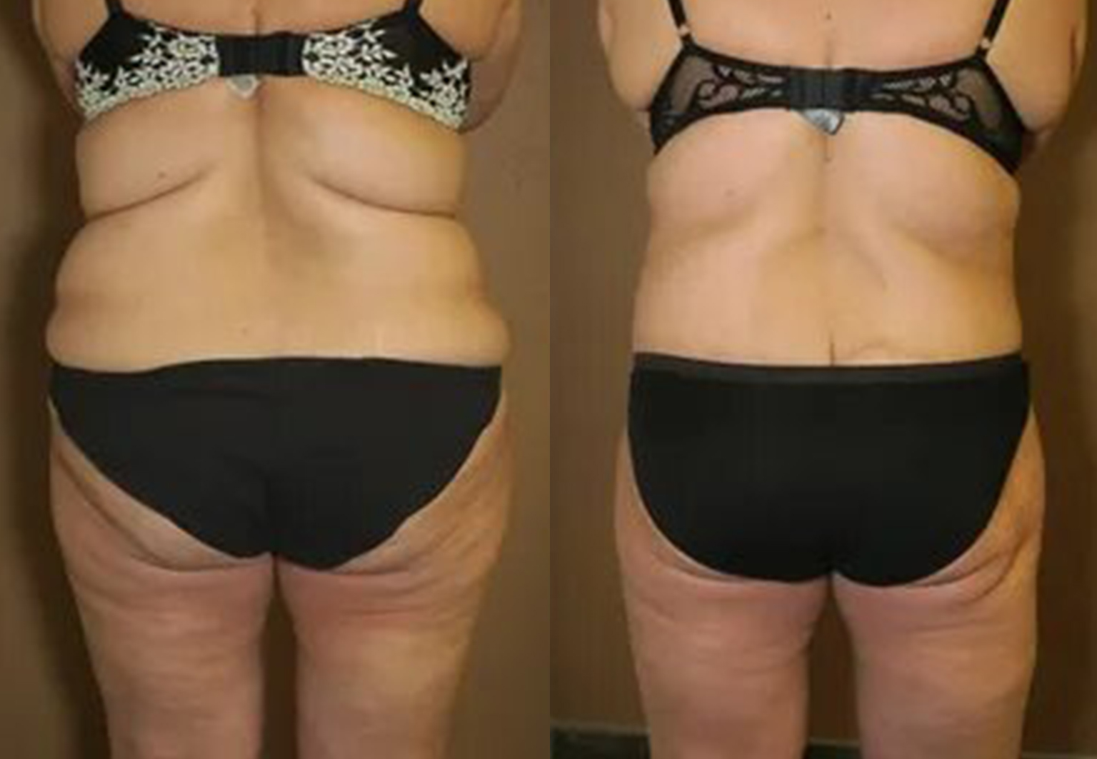 CareBridge - Tight Lift - Before and after [04]