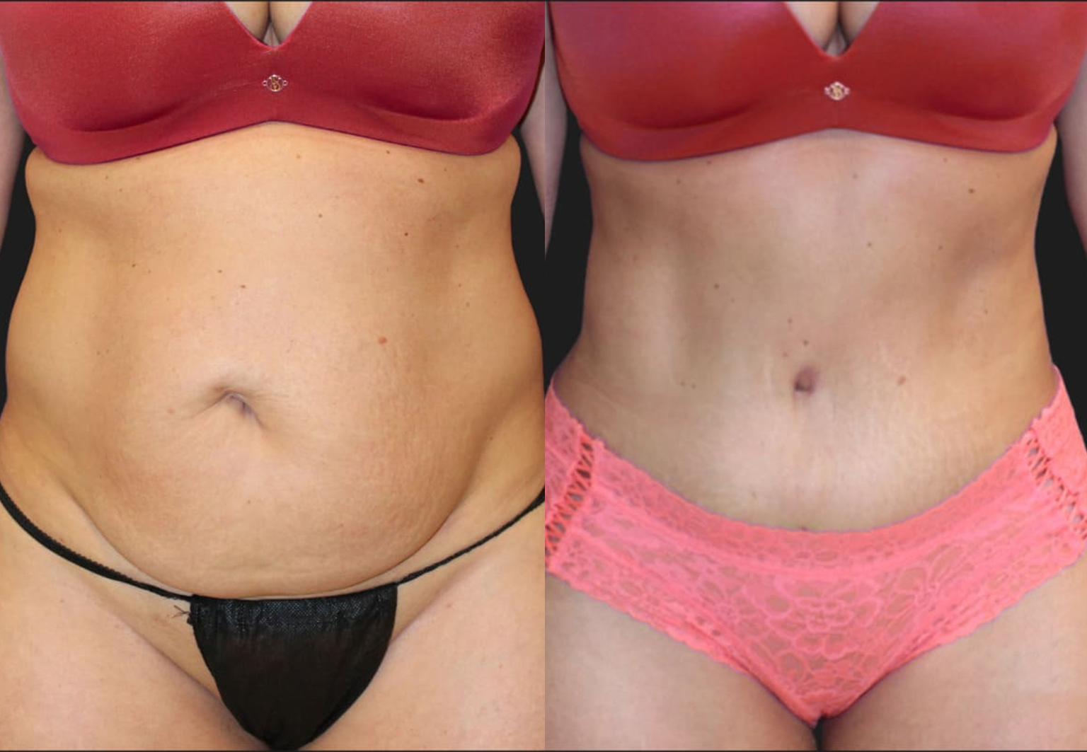 CareBridge - Tummy Tuck - Before and after [01]