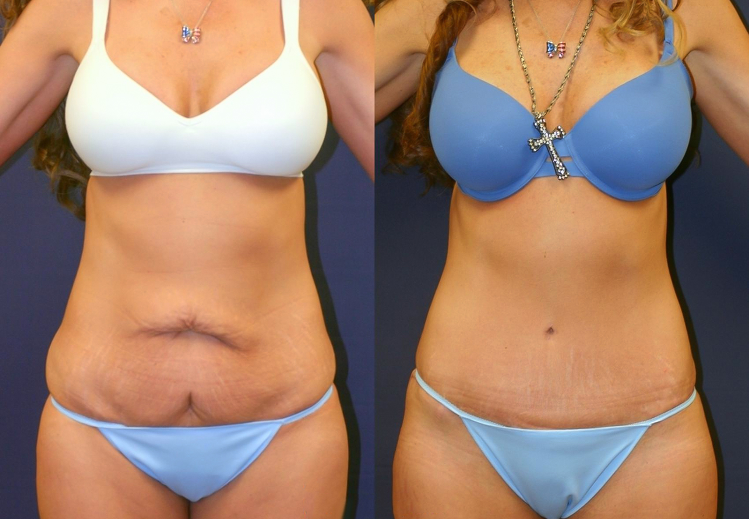 CareBridge - Tummy Tuck - Before and after [02]