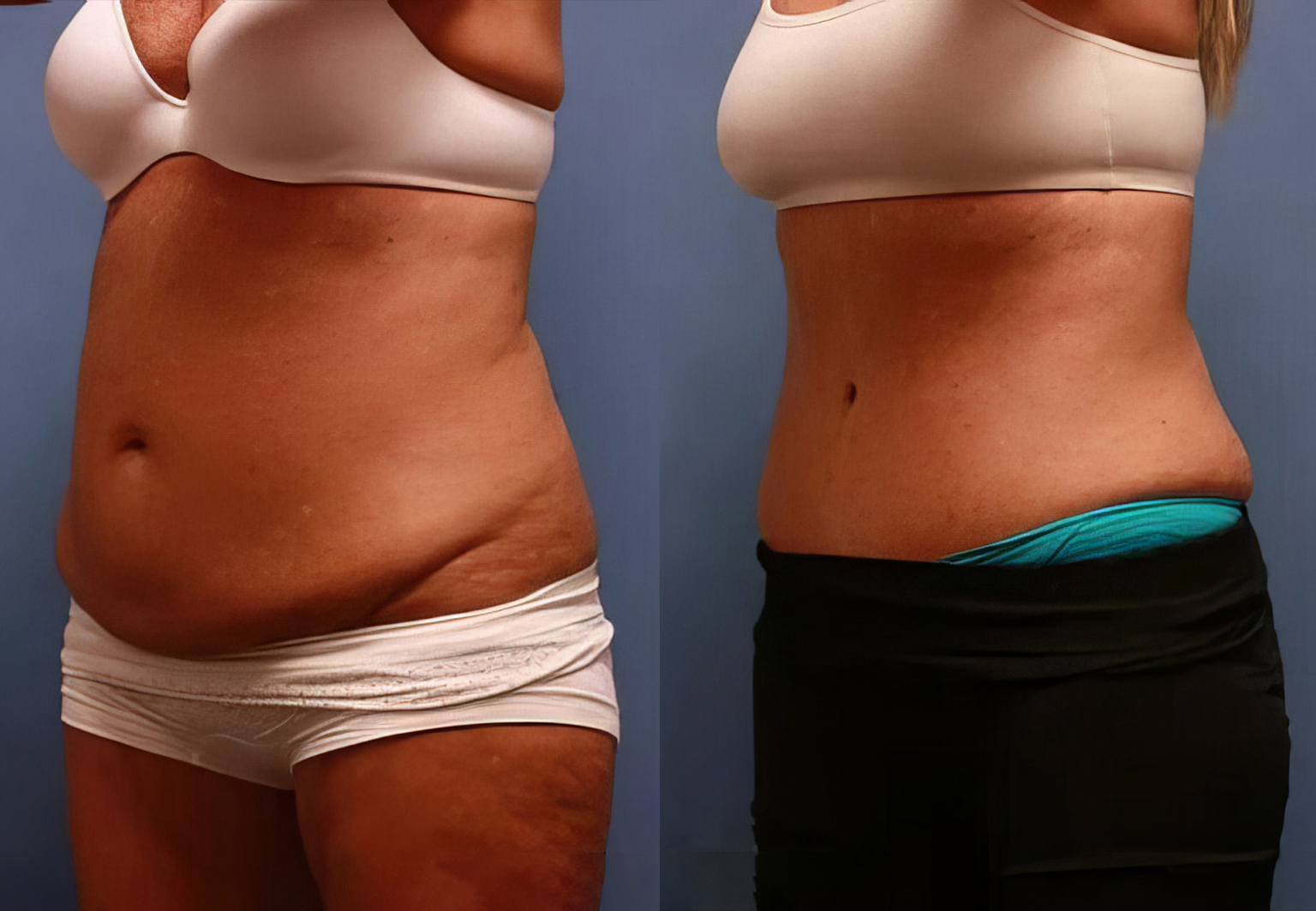 CareBridge - Tummy Tuck - Before and after [04]