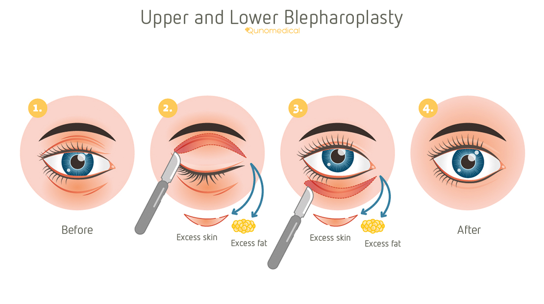 Eyelid Surgery (Blepharoplasty) in Turkey with Care Bridge US process Eyelid Surgery (Blepharoplasty) in Turkey with Care Bridge US process