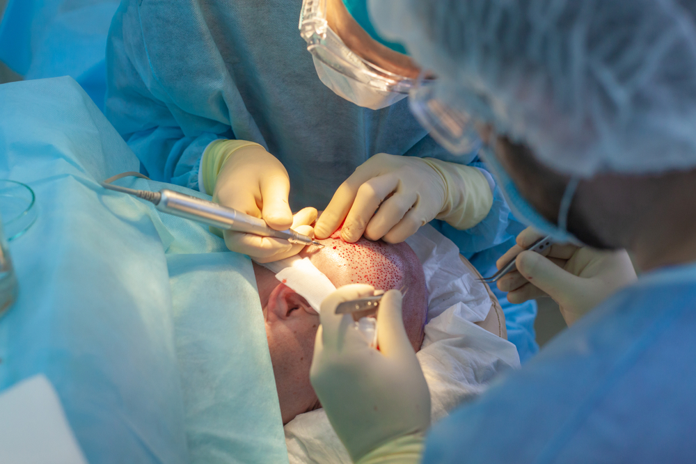 FUE Hair Transplant In Turkey with Care Bridge US