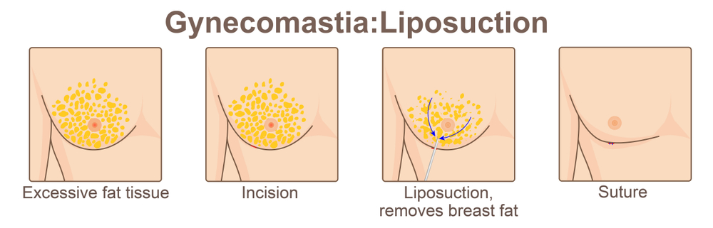 Gynecomastia procedure process in Turkey With Care Bridge US https://carebridgeus.com/wp-content/uploads/2026/05/Gynecomastia-procedure-process-in-Turkey-With-Care-Bridge-US.png