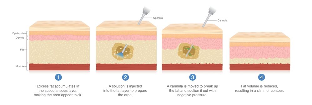 Liposuction in Turkey with Care Bridge US Procedure step by step https://carebridgeus.com/wp-content/uploads/2026/05/Liposuction-in-Turkey-with-Care-Bridge-US-Procedure-step-by-step-e1779170692480.jpg