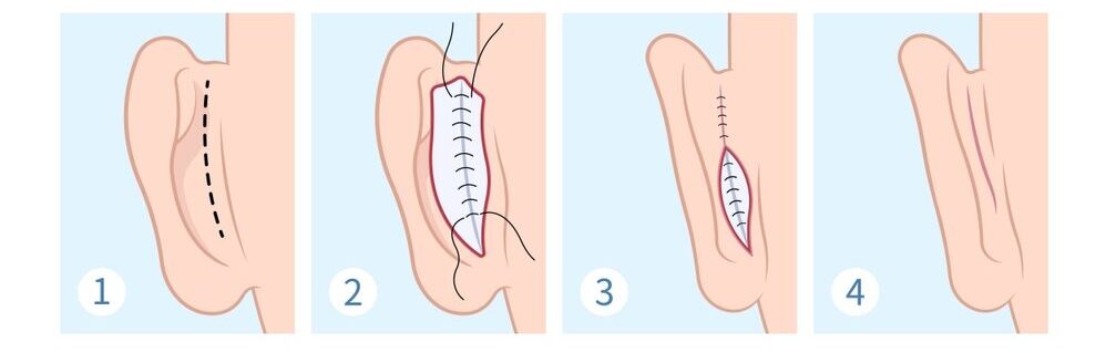 Otoplasty in Turkey With Care Bridge US
