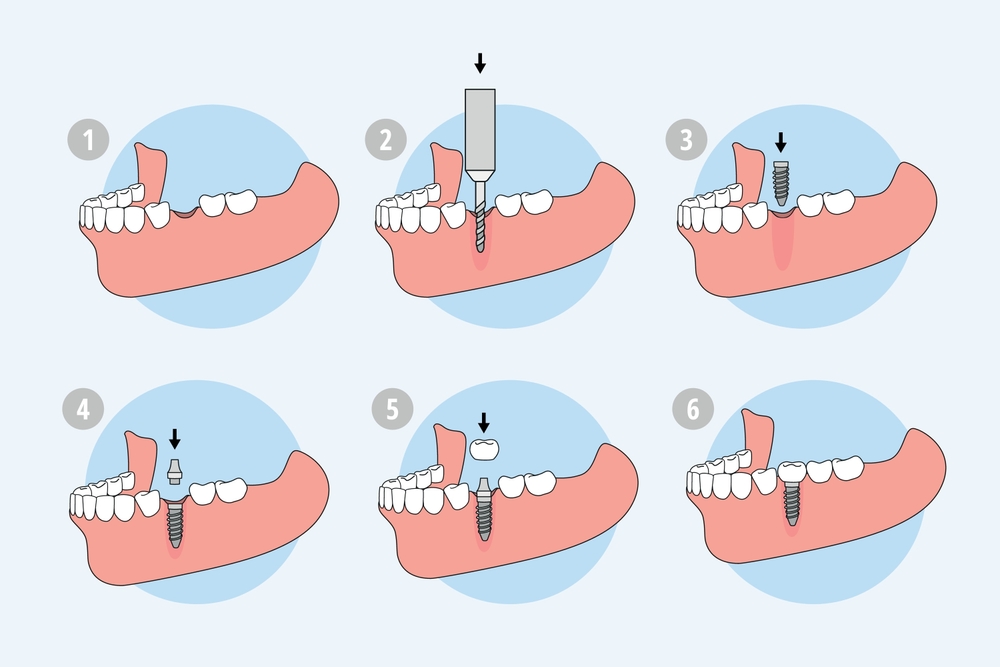 Dental,Implant,Procedure,Explained,Step,By,Step https://carebridgeus.com/wp-content/uploads/2026/05/Step-by-step-dental-implant-procedure-.jpg