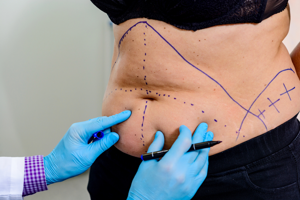 Tummy Tuck in Turkey with Care Bredge US