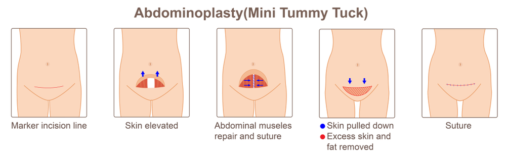Tummy Tuck in Turkey with Care Bredge US - The process