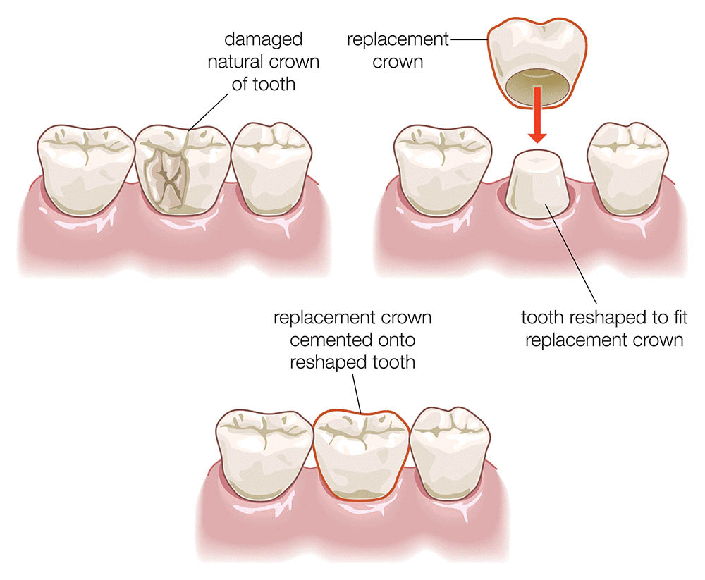 dental crown procedure in Turkey llustration - Care Bridge US