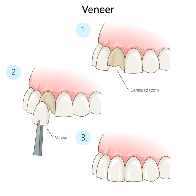 dental-veneer-in-Turkey-with-Care-Bridge-Us-treatment-process dental-veneer-in-Turkey-with-Care-Bridge-Us-treatment-process