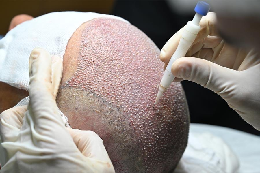 dhi-hair-transplant-In-Turkey-with-Care-Bridge-US
