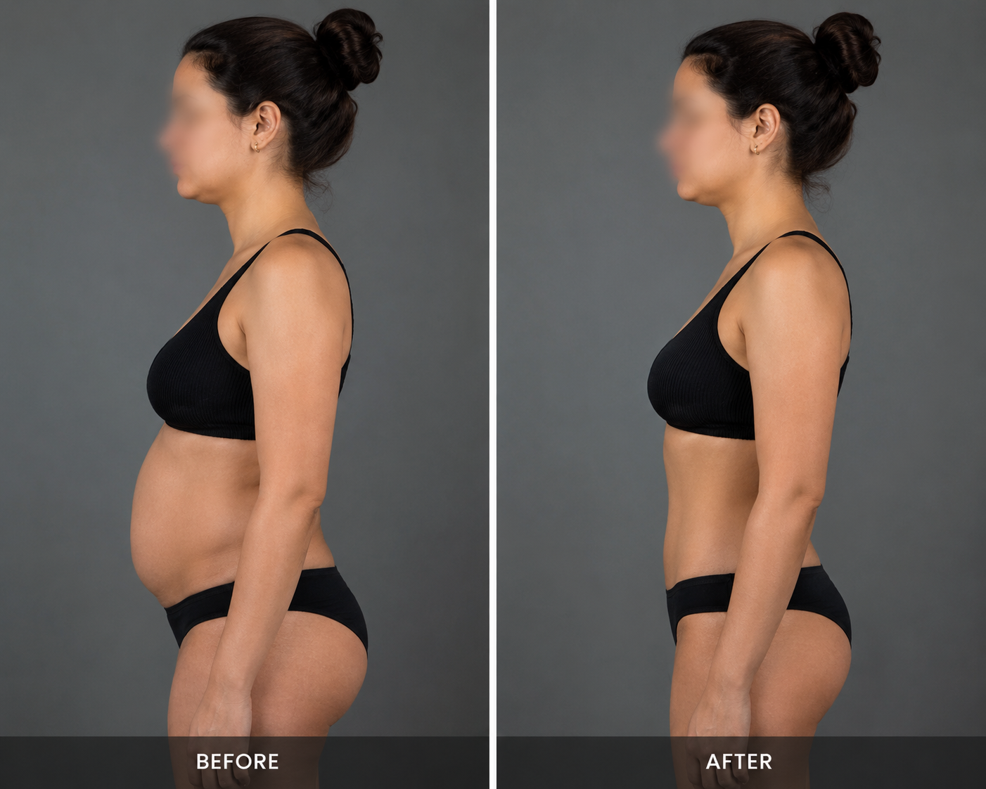 https://carebridgeus.com/wp-content/uploads/2026/05/lipo-carebridge.png