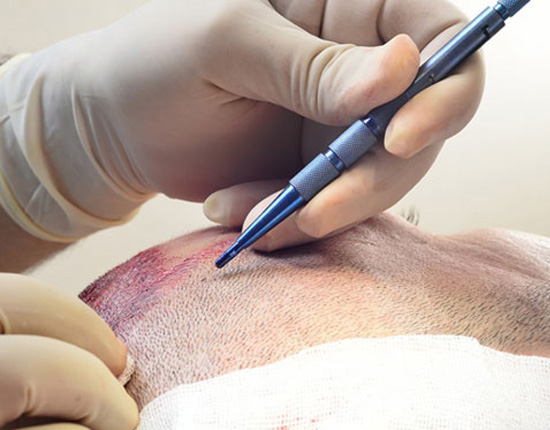 https://carebridgeus.com/wp-content/uploads/2026/05/sapphire-fue-pen.jpg