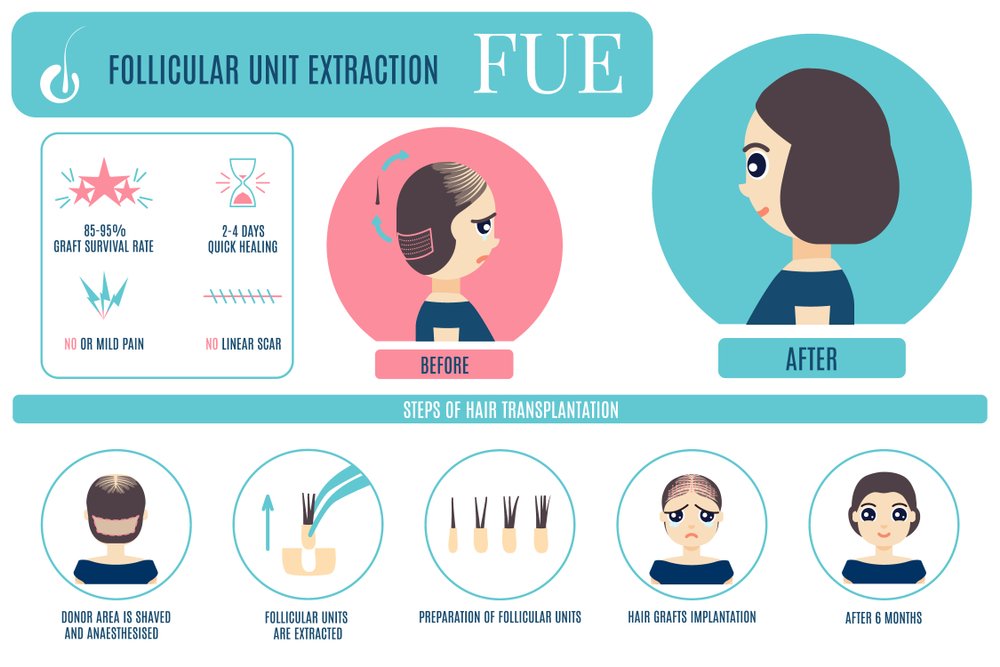 women’s hair transplant process in Turkey with Care Bridge US