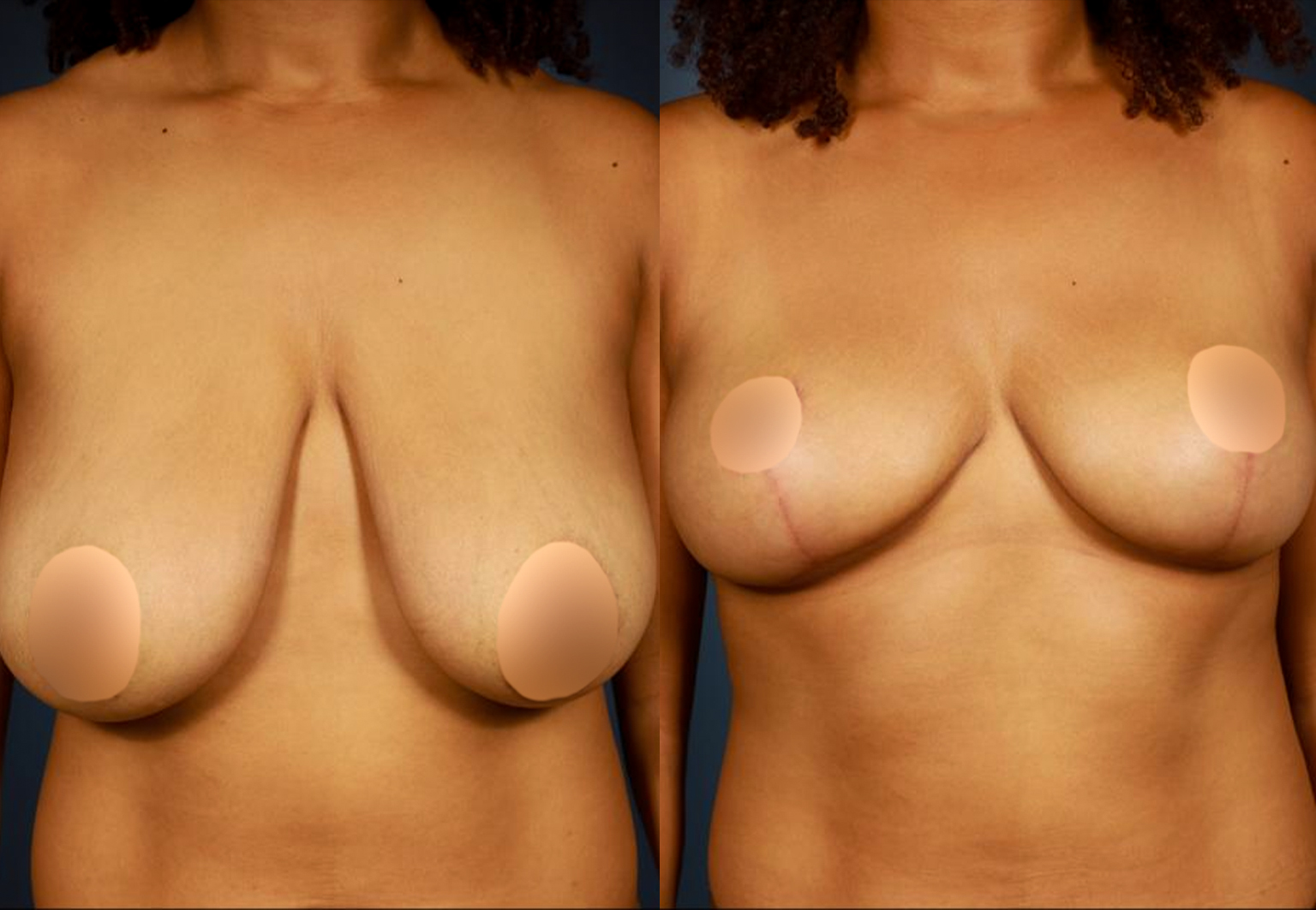 CareBridge_-_Breast_Surgery_-_Before_and_after_14