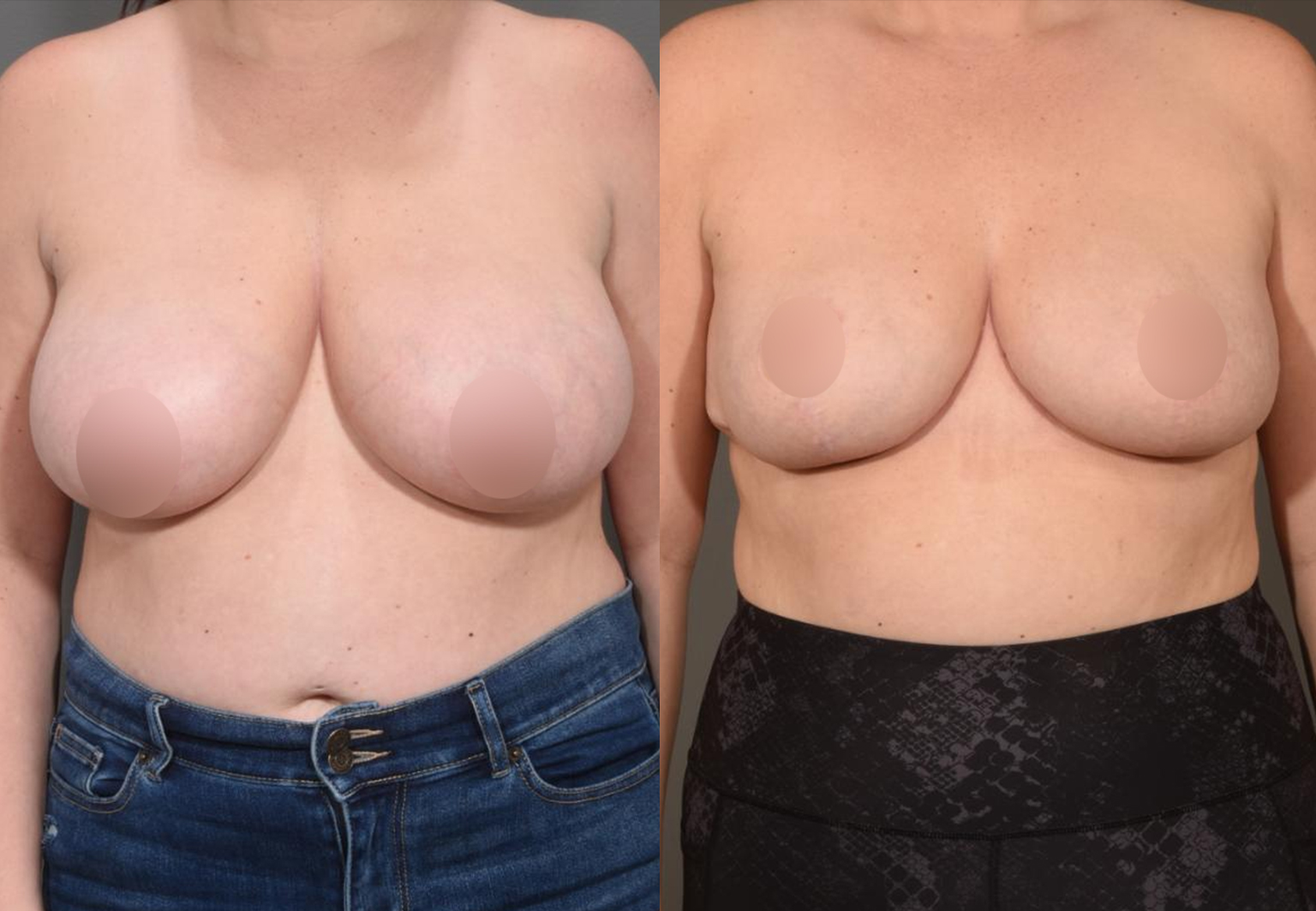 CareBridge_-_Breast_Surgery_-_Before_and_after_16