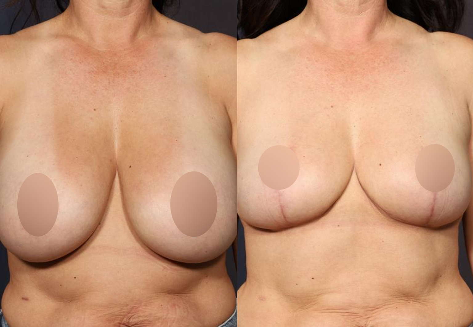 CareBridge_-_Breast_Surgery_-_Before_and_after_17