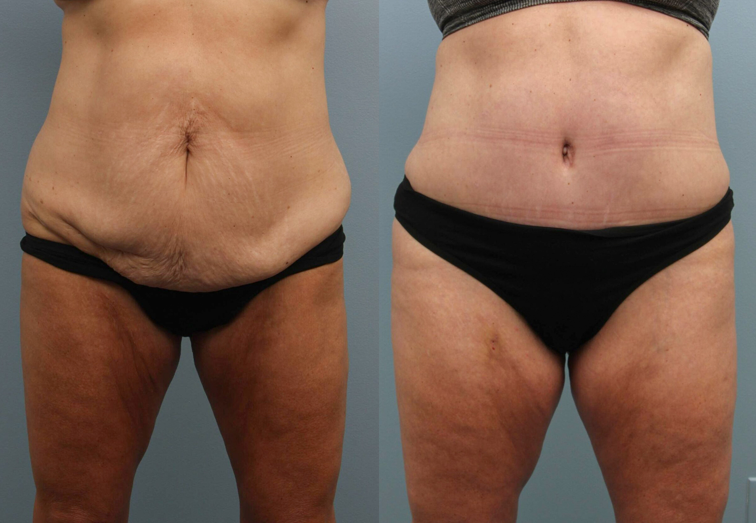 CareBridge_-_Liposuction_-_Before_and_after_02