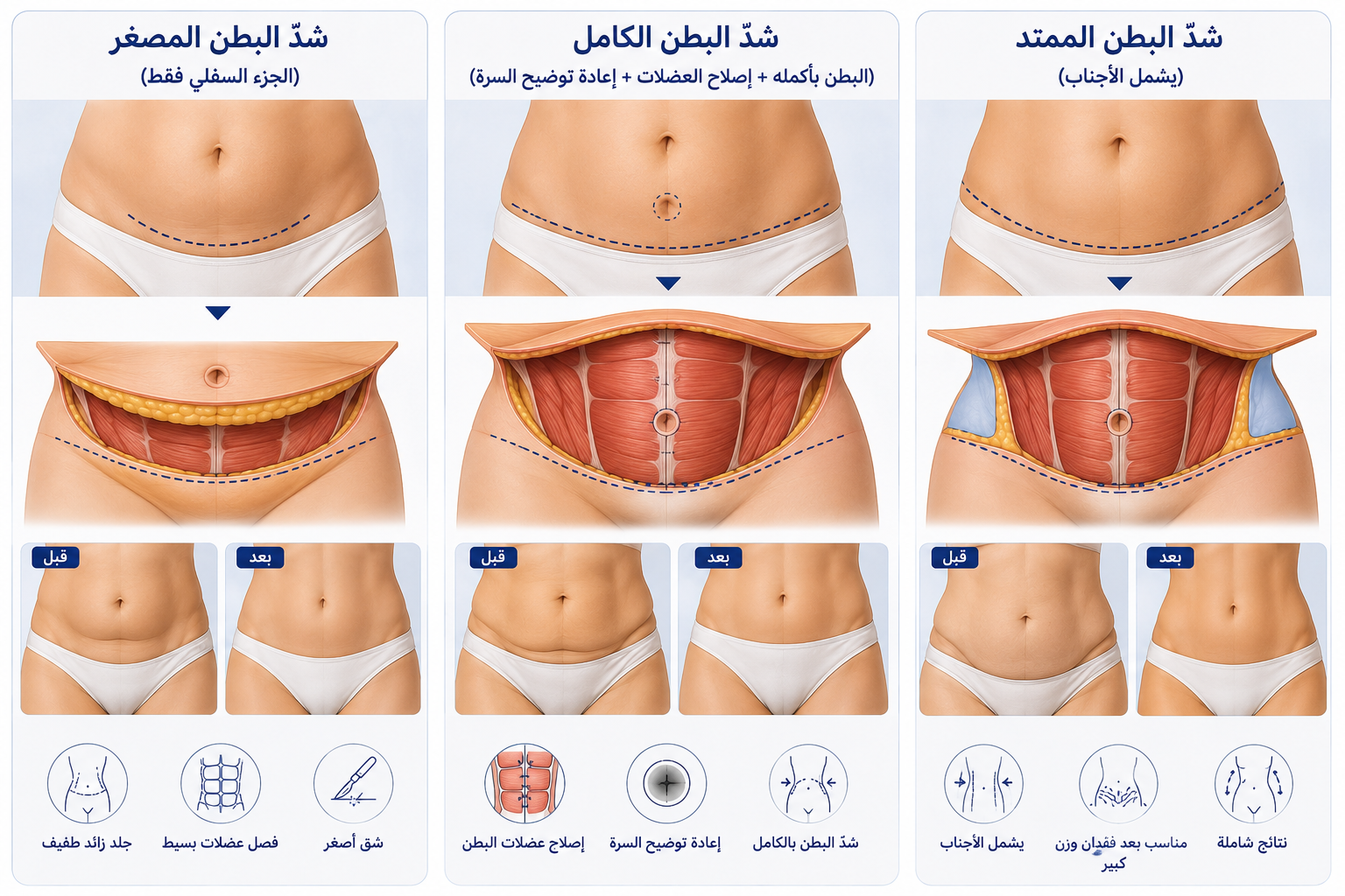 أنواع عمليات شدّ البطن - Care Bradge US أنواع عمليات شدّ البطن - Care Bradge US