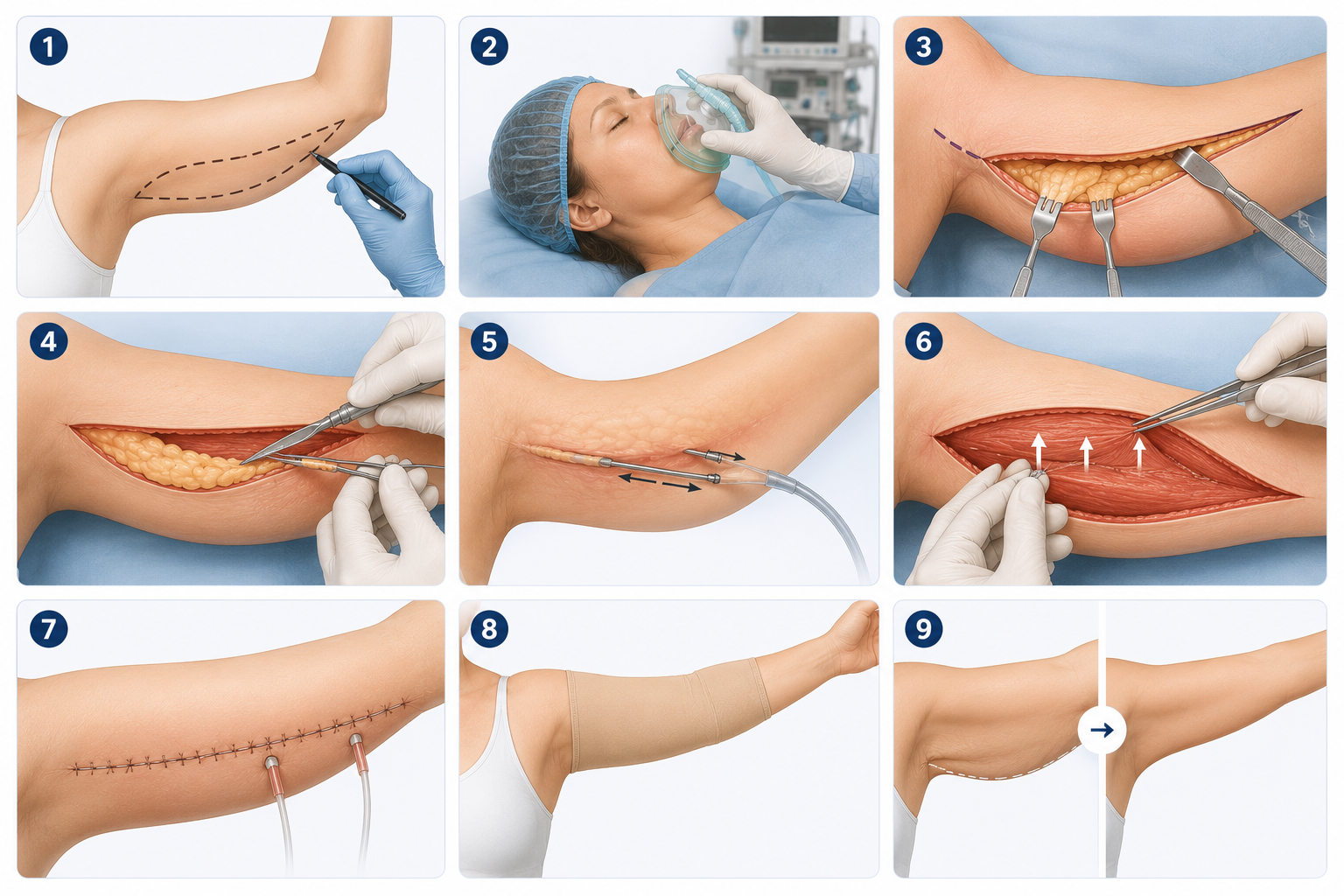 مراحل عملية شدّ الذراعين في تركيا - Care Bridge US